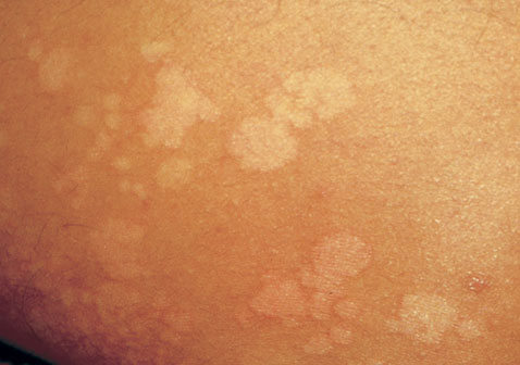 汗斑花斑癣的症状图片：皮肤外观样子