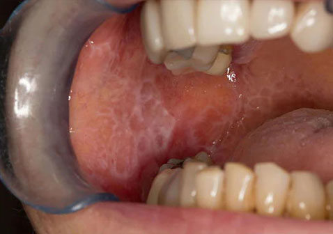 口腔苔藓症状与图片：舌头、脸颊