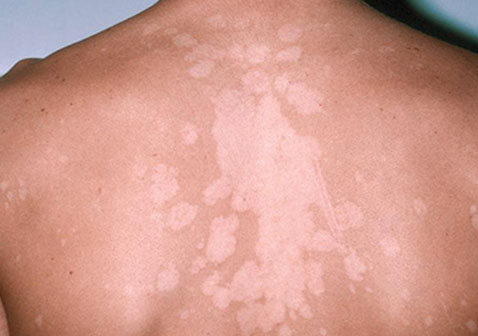 皮肤白斑是什么皮肤病引起的原因对照图片