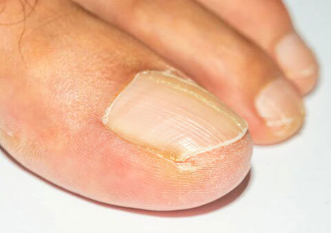 最轻微的灰指甲和白色浅表灰指甲的初期症状迹象图片