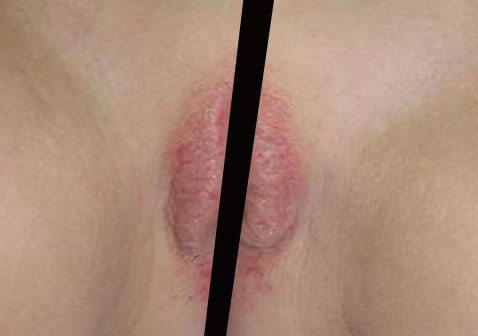 女性生殖器外阴湿疹症状真实图片