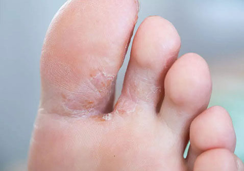 水泡型脚气足癣怎么治疗才能根除用什么药