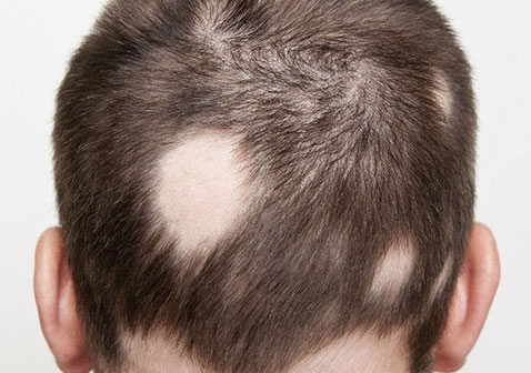 斑秃是什么原因造成的怎么治疗方法图片