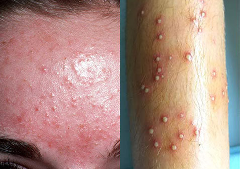 痤疮痘痘和毛囊炎的区别对比图片
