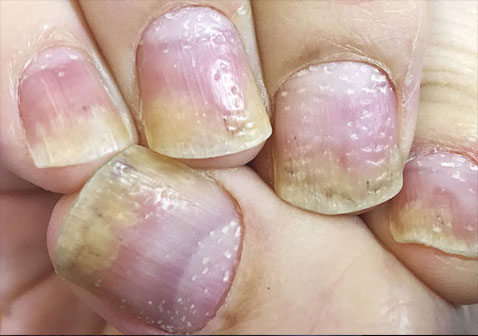 指甲牛皮癣银屑病早期症状图片怎么治疗