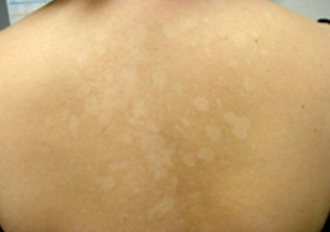 皮肤白斑是什么皮肤病图片及症状治疗方法