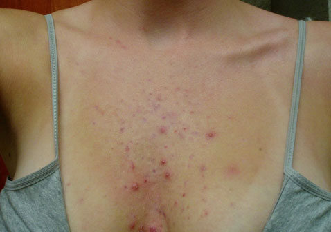 胸前后背长痤疮痘痘图片和症状征兆