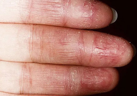 真菌性湿疹症状图片怎么治疗及引起的原因
