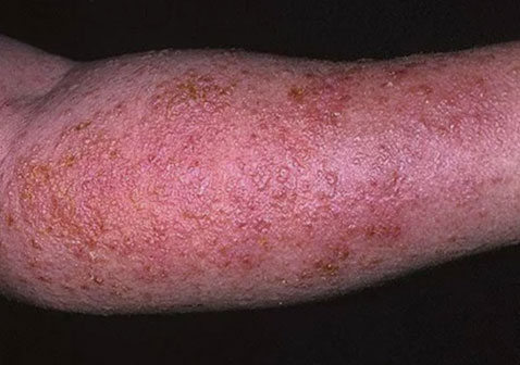 各种湿疹性红疹图片初期症状图片对照查看大全