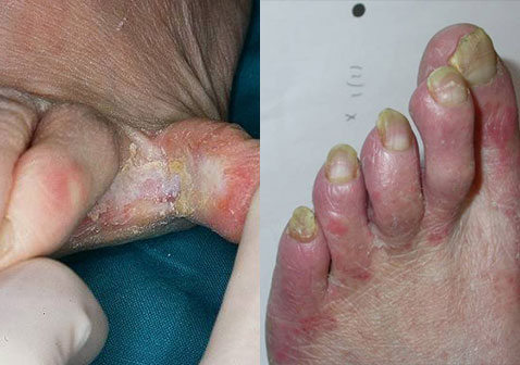灰指甲和脚气是一种菌吗及区别对比图片