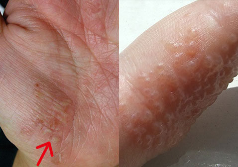 掌跖脓疱病和汗疱疹的区别对比图片