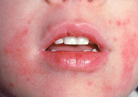 婴儿皮炎湿疹症状图片大全及治疗