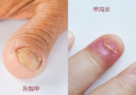 甲癣灰指甲和甲沟炎的区别对比图片