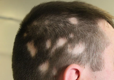 斑秃脱发严重怎么治疗才有效有什么方法解决大全