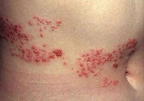 带状疱疹疾病：带状疱疹会传染吗