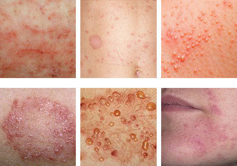 引起皮肤病的原因是什么造成的怎么治疗及图片样子