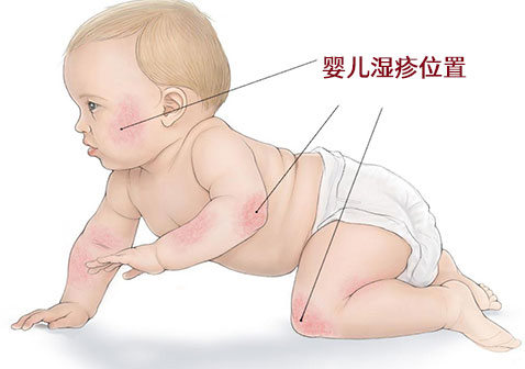 2022最新婴儿湿疹最佳治疗方法指南图片