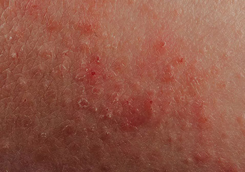 皮炎性湿疹的症状图片及初期症状
