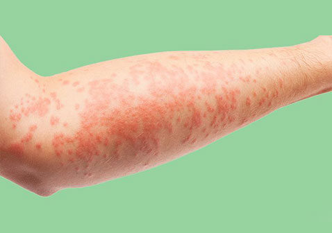 特应性皮炎湿疹的症状图片传染吗