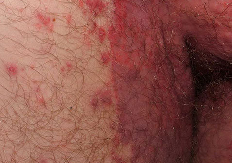 男性内侧股癣用什么药膏最好图片：抗真菌和激素药膏