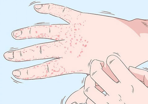 手上长湿疹初期症状图片：手掌，手背