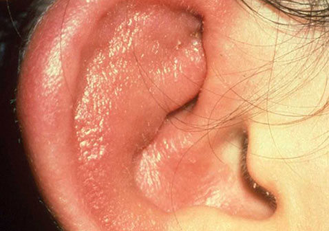 湿疹图片初期症状图片大全：耳朵，手掌手背，疱疹