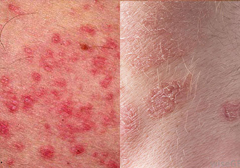 不同部位的过敏性皮炎皮疹与牛皮癣区别图片对比