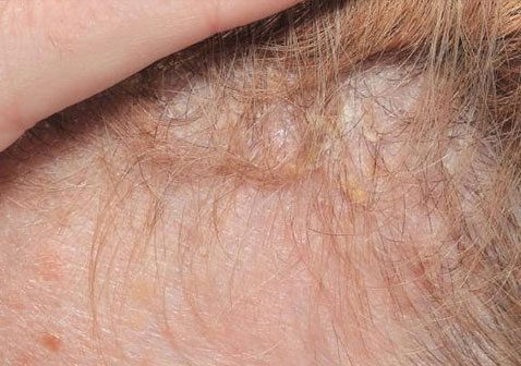 头皮牛皮肤癣初期症状图片如何治疗能好