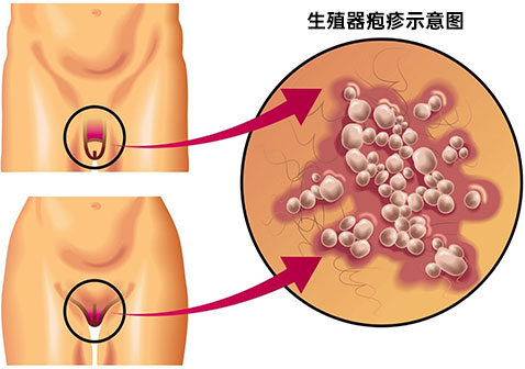 什么是生殖器疱疹（附图片）