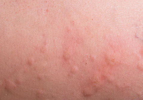 什么是荨麻疹（附图片）