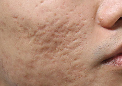 面部结节型痤疮痘痘疤痕图片