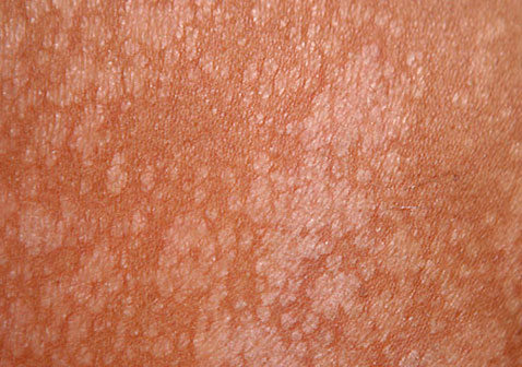 花斑癣汗斑（颈部、胸部、背部、手臂皮肤）的症状图片