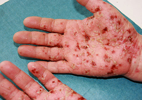 手掌脓疱病或掌跖脓疱病是什么原因引起的