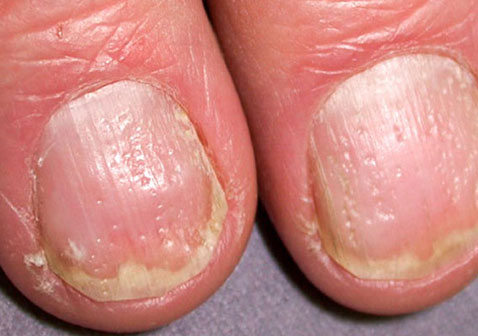 为什么银屑病会导致指甲有小坑怎么治疗及症状图片