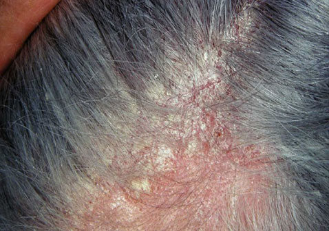 头皮型银屑病不能抠或抓挠的原因怎么办治疗方法