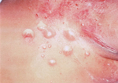 脓疱疮初期症状图片水泡形成