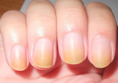 银屑病指甲初期和晚期指甲最严重图片症状特征