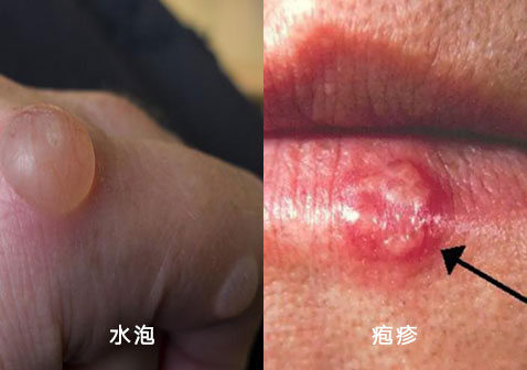 水泡和疱疹的区别图片