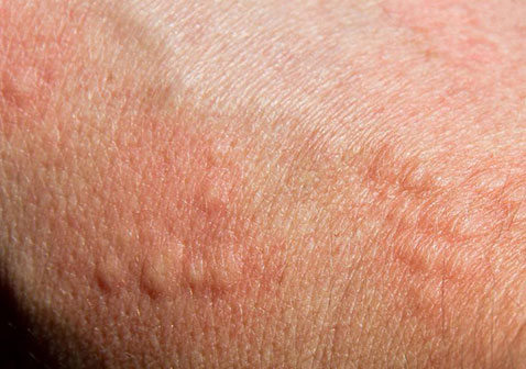 什么是慢性特发性荨麻疹图片