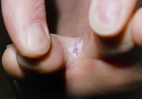 皮肤真菌感染的类型及其可能引起的症状图片