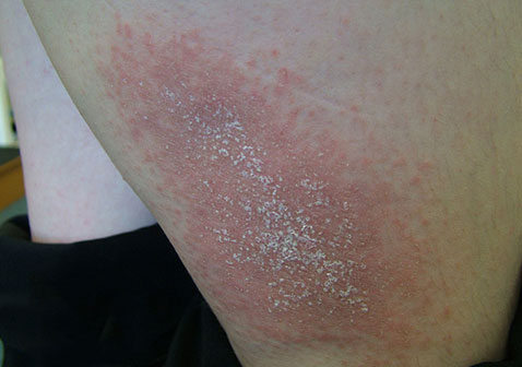 玫瑰糠疹图片 ：背部，脚部，脖子，手臂，腿部