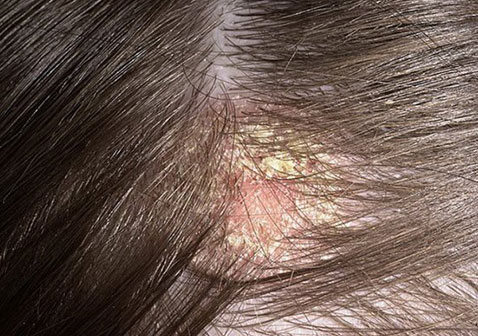 头部脂溢性皮炎是什么样子：原因症状和治疗方法