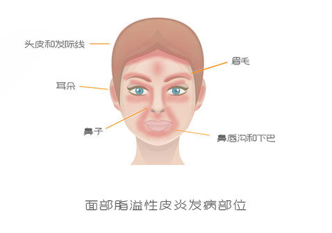 面部脂溢性皮炎怎么治：皮肤科医生的治疗技巧