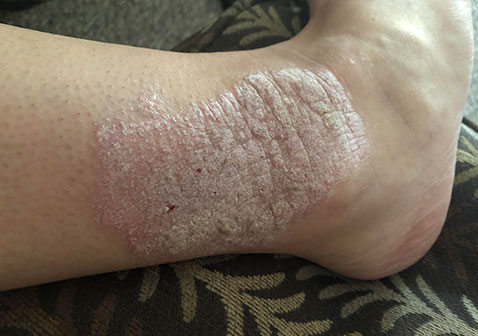 脚踝银屑病鳞屑厚对身体影响大吗及危险并发症图片
