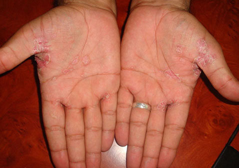 手掌心牛皮癣症状图片是什么原因引起的怎么治疗