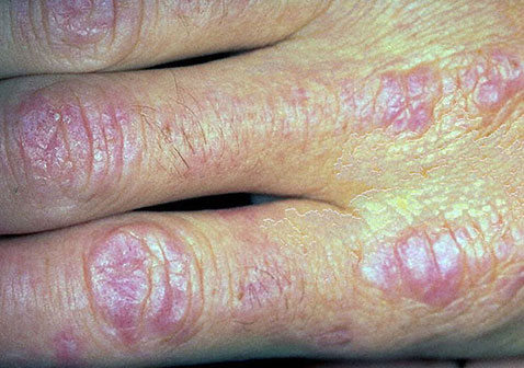 手牛皮癣症状图片发生在手指关节处