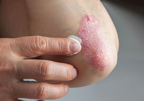 银屑病症状初期图片：小红点，指甲，脓疱型，红皮型