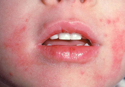 儿童皮肤病的种类图片名称湿疹
