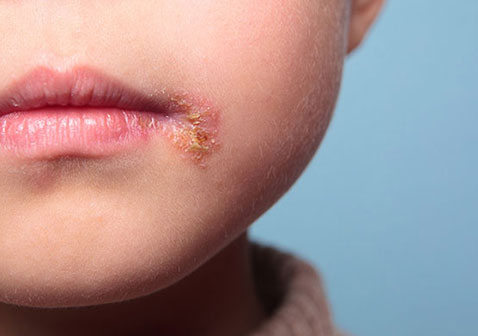 儿童皮肤病的种类图片名称脓疱疮