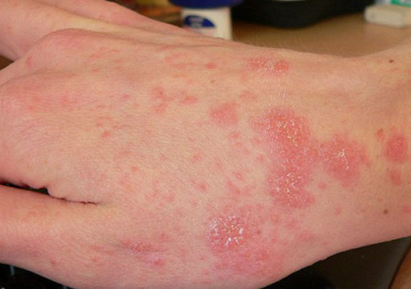疥疮和湿疹的区别图片